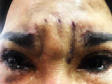 TP.HCM: Đi treo chân mày bằng chỉ để “bớt già”, người phụ nữ bị biến dạng mắt