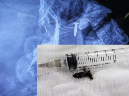 Những tấm phim chụp X-quang kinh dị nhất mà bạn từng thấy: bị mũi khoan, dao sắc hay đinh nhọn xuyên thủng hộp sọ vẫn sống sót-14