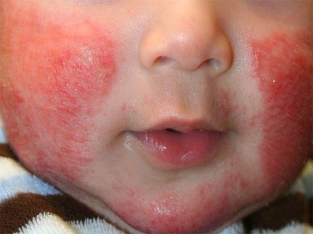 Tự tắm nước lá cây chữa bệnh về da - Chuyên gia cảnh báo biến chứng nguy hiểm