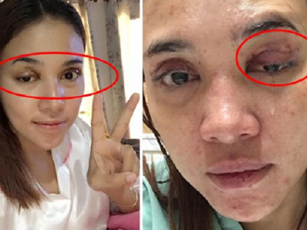 Thảm cảnh cắt mí, đôi mắt long lanh đâu chưa thấy, chỉ thấy ngay 2 đường lượn sóng kinh hoàng-6