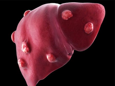 Chuyên gia BV Ung bướu chỉ rõ 4 nhóm người dễ mắc ung thư gan nhất: Biết sớm để đề phòng