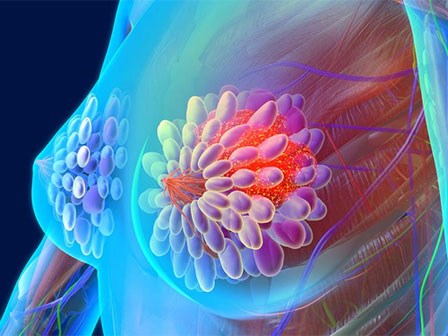 Chuyên gia chỉ cách tự phát hiện bệnh ung thư rất nguy hiểm chị em nào cũng cần thuộc lòng