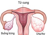 Ung thư buồng trứng và những điều cần biết-4