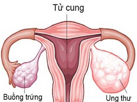 Phát hiện mới: ung thư buồng trứng có thể không phát sinh từ buồng trứng