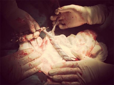 Hi hữu ca sinh đôi có 2 dây rốn xoắn như tết tóc