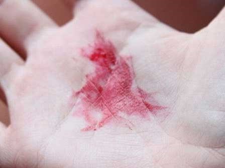 Ho ra máu, tá hoả phát hiện khối u