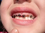 Ngậm nước lá chanh đun đặc – Bài thuốc” trị sâu răng, viêm lợi, hôi miệng hiệu quả đến 90%-2