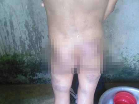 Trẻ 12 tuổi bị đánh đòn bầm dập vì nghi trộm 500 nghìn đồng