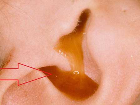 Nhét tỏi vào lỗ tai để trị đau tai gây mất ngủ, người đàn ông phải nhận kết đắng-3