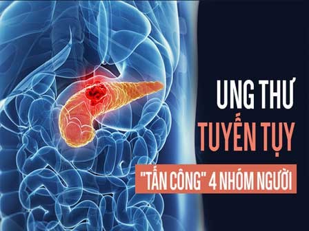 Ung thư tụy rất nguy hiểm vì khó chữa, ai có 4 đặc điểm này hãy đặc biệt cẩn thận