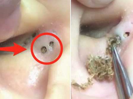 Đứa trẻ 10 tuổi phải phẫu thuật não, chỉ vì mẹ nặn mụn đầu đen ở mũi-4