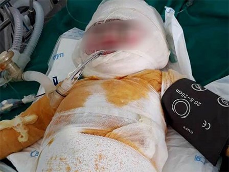 Con ngã vào hố vôi đang sôi, mẹ tuột da, thịt thò tay kéo con lên