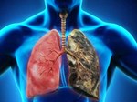 Ung thư phổi là bệnh có tiên lượng xấu: Chuyên gia chỉ rõ những dấu hiệu của bệnh-4