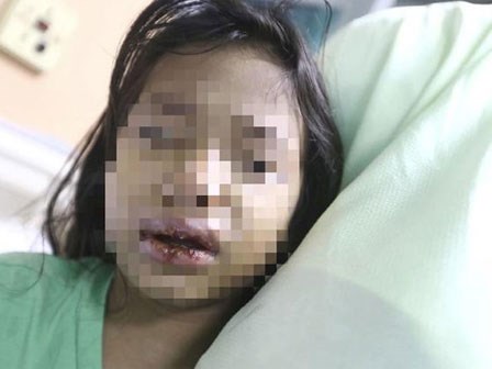 Đón con ở nhà chồng cũ, mẹ sốc nặng phát hiện con bị mẹ kế đánh, ép uống nước sôi