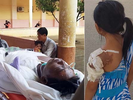 Vợ tạt nước sôi khiến chồng nguy kịch, con bị thương