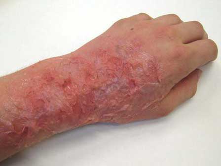 Sai lầm khi sơ cứu bỏng của cha khiến con trai 4 tuổi bị ngộ độc đến mức nhập viện-3