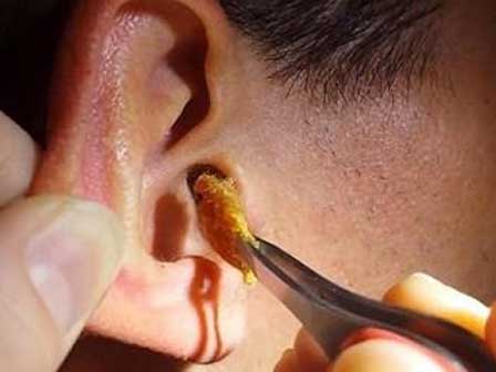 Bé trai 3 tuổi bỗng nhiên mất thính lực, đến khi bác sĩ lôi được thứ trong tai ra ai cũng rùng mình kinh sợ-4