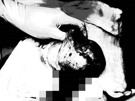 Bé gái 13 tuổi bất ngờ bị cắt bỏ một bên buồng trứng sau cơn đau quặn bụng