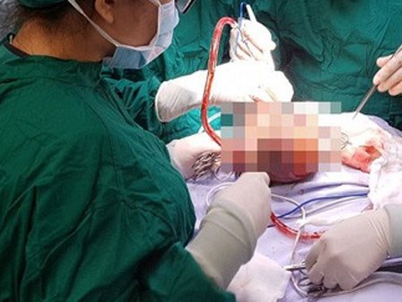 Thai phụ 19 tuổi ở Sài Gòn sinh bé gái mang khối u quái dị hình dạng như bào thai