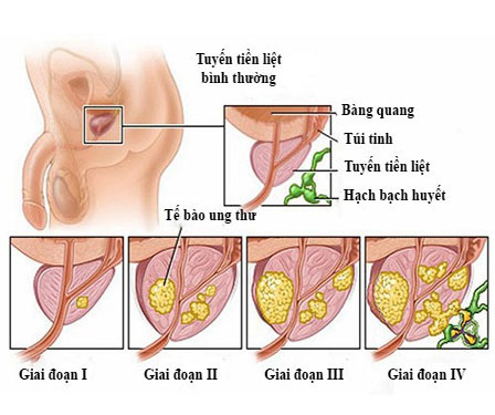 Yếu tố làm tăng nguy cơ mắc ung thư tuyến tiền liệt mà nam giới cần biết-4