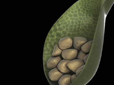 Ăn lựu mỗi ngày, người phụ nữ trẻ khiến bác sĩ giật mình khi thấy thứ nằm trong bụng-4