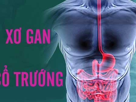 Dừng ngay việc uống rượu bia nếu không muốn bị xơ gan cổ trướng