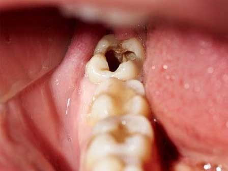 Răng số 8 - răng khôn mọc... dại: Khi nào cần nhổ, nhổ có nguy hiểm không?