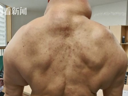 Cơ thể quý ông nổi đầy u mỡ, biến dạng như quái vật vì uống 1 lít rượu mỗi ngày
