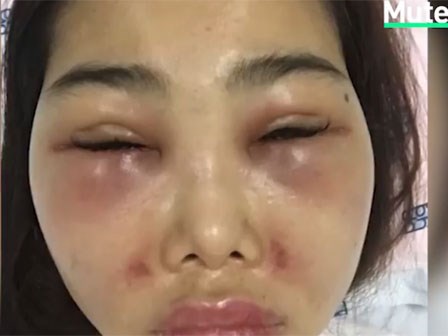 Cô gái mặt biến dạng vì tiêm chất làm đầy