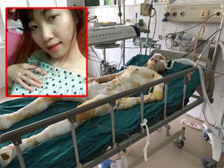 Nghi do mâu thuẫn bạn bè, cô gái xinh đẹp bị tẩm xăng thiêu sống trong lúc ngủ, mức độ bỏng toàn thân 92%
