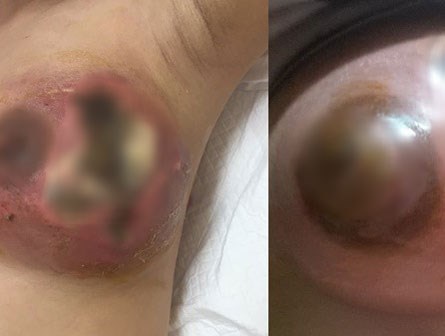 Trải nghiệm kinh hoàng của người mẹ thập tử nhất sinh vì chữa tắc sữa bằng phương pháp dân gian