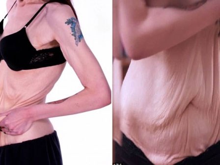 Hậu giảm cân, cô gái bị trầm cảm nặng vì làn da chảy xệ