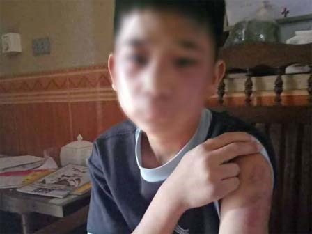 Bố đẻ cùng mẹ kế đánh đập bé trai 14 tuổi bầm tím khắp cơ thể