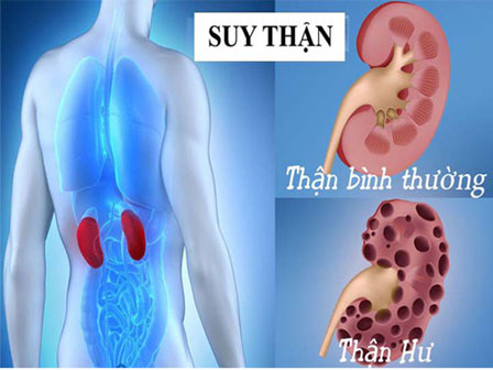 Bác sĩ BV Bạch Mai cảnh báo thói quen hại thận rất nhiều người mắc mà không biết-3