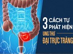 Căn bệnh ung thư xếp hàng thứ tư ở Việt Nam - thủ phạm liên quan chặt chẽ tới dinh dưỡng-3