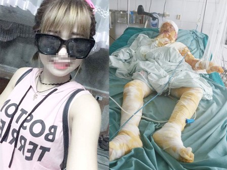 Hoàn cảnh bi đát của cô gái trẻ lao vào cứu bạn trong vụ bị người tình tẩm xăng thiêu sống