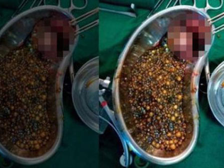 Mẹ mắc sai lầm khi nấu nướng khiến con 3 tuổi bị sỏi mật, đừng chăm con như vậy!-4