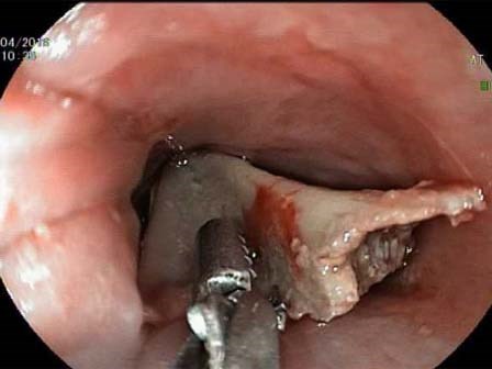 Vừa xem tivi vừa ăn đùi gà, bé gái 13 tuổi ở Bình Dương suýt chết vì nuốt xương