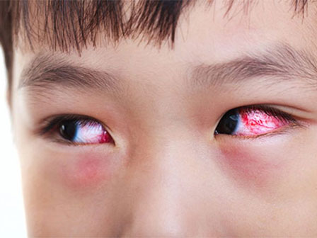 Bệnh đau mắt đỏ - một trong những bệnh cần tránh trong mùa hè-5