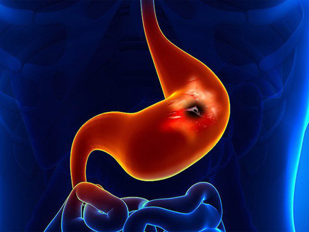 Chuyên gia khuyến cáo thủ phạm có thể gây ung thư dạ dày người Việt hay mắc-3