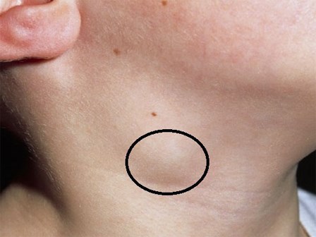 Sưng, nổi hạch trên người: Khi nào nên để tự khỏi, khi nào nên đi khám để phòng ung thư