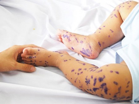 Ba dấu hiệu sớm cảnh báo diễn biến nặng của bệnh tay chân miệng ở trẻ