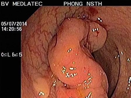 Bé 10 tuổi bị ung thư đại trực tràng giai đoạn cuối, 5 yếu tố gây bệnh rất đáng lưu ý