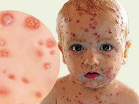 Bệnh thủy đậu kiêng gì và nên ăn gì để nhanh khỏi-9