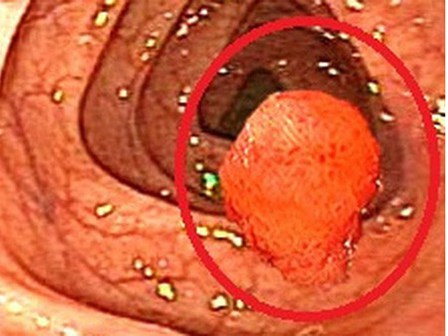 Chuyên gia Bệnh viện K trung ương vạch mặt thủ phạm có thể khiến cả gia đình bị ung thư
