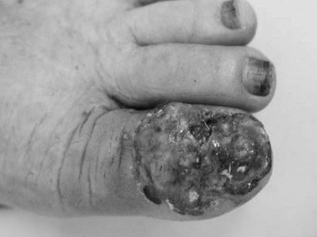 Cô gái 26 tuổi bị ung thư sau khi tẩy nốt ruồi, 10 kiểu nốt ruồi cần đi khám gấp-6