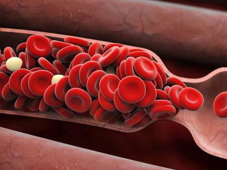 6 dấu hiệu cảnh báo cục máu đông: Nhiều người nhầm lẫn nên gặp nguy hiểm, thậm chí tử vong