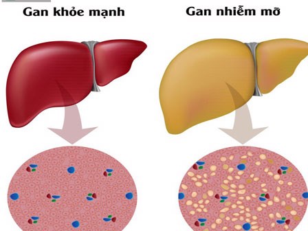 Nguyên nhân gây ra gan nhiễm mỡ và cách khắc phục: Đừng để mắc bệnh rồi mới đề phòng