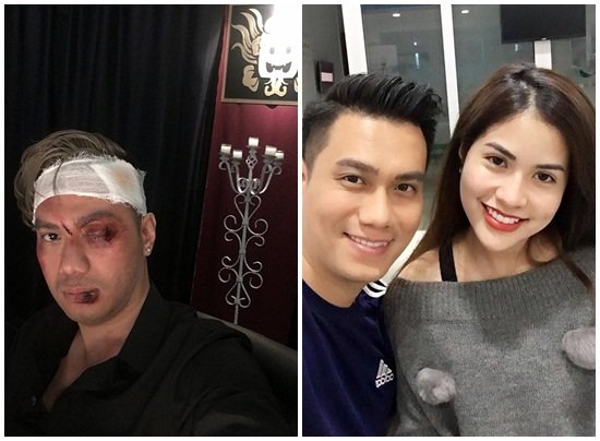 Hình ảnh diễn viên Việt Anh bị đánh thâm tím mặt mày gây chú ý-1