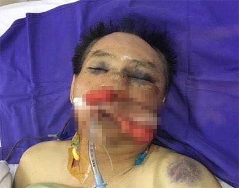 Nguyên đại tá công an đánh vợ chồng anh trai dập phổi